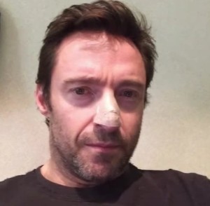 hugh jackman nose skin cancer bandage