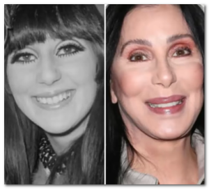 cher plastic surgery before after
