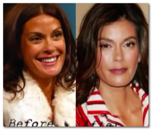 teri hatcher plastic surgery before after