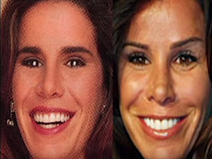 melissa rivers plastic surgery before after